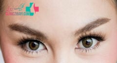 عمل چشم گربه ای در شیراز