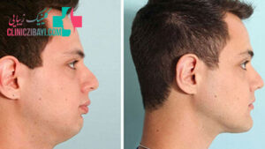 عکس های قبل و بعد جراحی فک و صورت