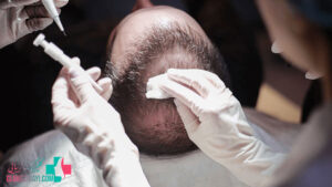 کاشت مو به روش DHI (دی اچ آی) و ویژگی های آن