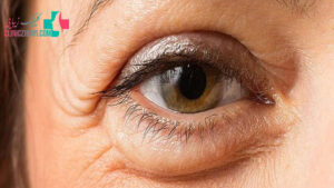 جدیدترین روش درمان پف زیر چشم چیست؟