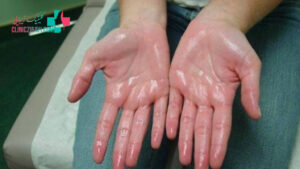 ۴ درمان خانگی برای عرق کردن دست و پا