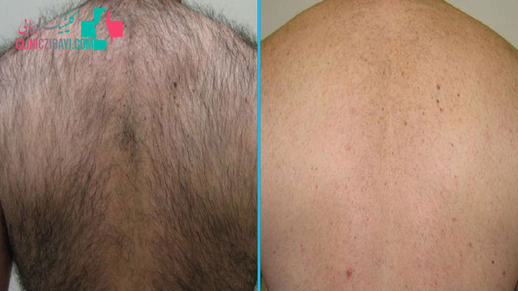آیا لیزر برای از بین بردن همیشگی مو در مردان موثر است؟