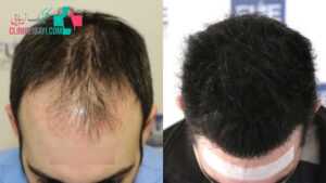 وارد شدن ضربه به سر بعد از کاشت مو چه خطراتی دارد؟