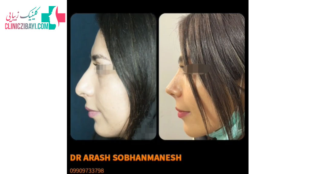 جراحی بینی توسط دکتر سبحان منش در شیراز