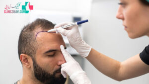 بهترین کلینیک کاشت مو در زعفرانیه تهران به همراه آدرس و شماره تماس