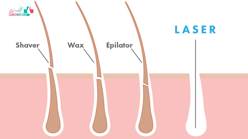 تاثیر لیزر بر روی مو‌های زائد در مراحل مختلف رشد مو