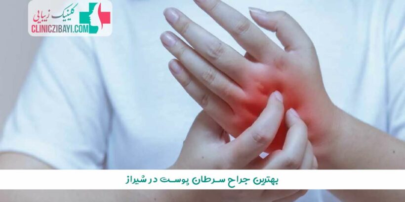 بهترین جراح سرطان پوست در شیراز