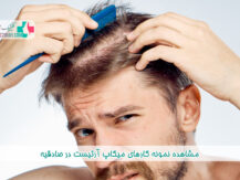 بهترین دکتر درمان ریزش مو در اسلامشهر