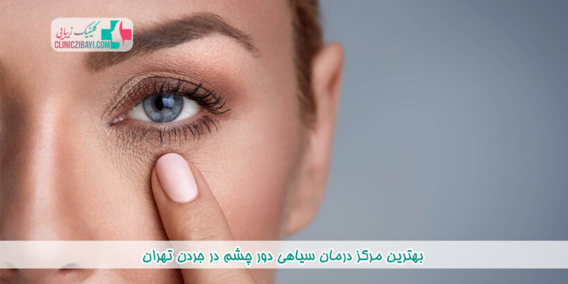 بهترین مرکز درمان سیاهی دور چشم در جردن تهران