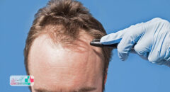 معایب و عوارض کاشت مو در دراز مدت چیست؟