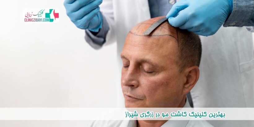 بهترین کلینیک کاشت مو در زرگری شیراز