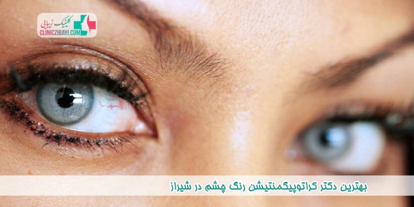 بهترین دکتر کراتوپیگمنتیشن رنگ چشم در شیراز