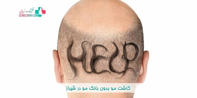 کاشت مو بدون بانک مو در شیراز