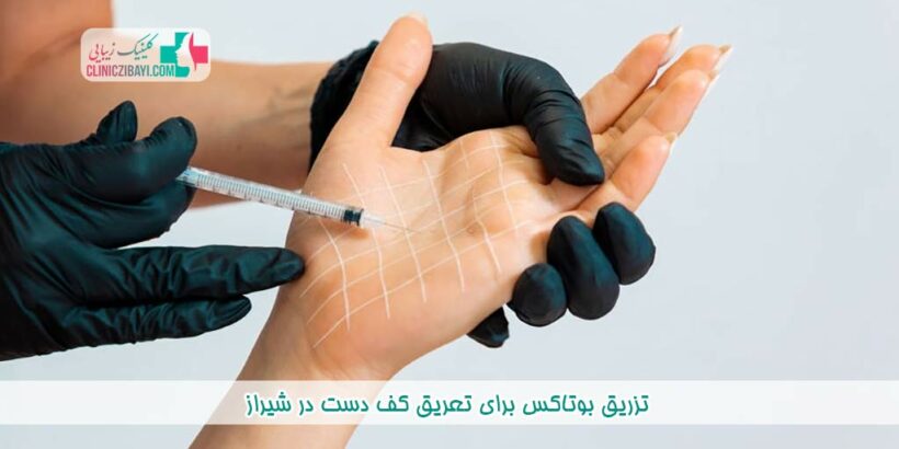 تزریق بوتاکس برای تعریق کف دست در شیراز