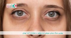 درمان سیاهی دور چشم در سعادت آباد تهران